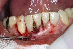 歯周ポケットと歯周外科